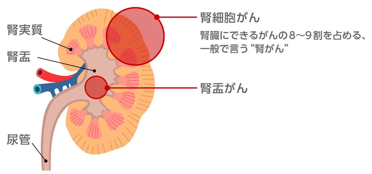 腎がんイメージ