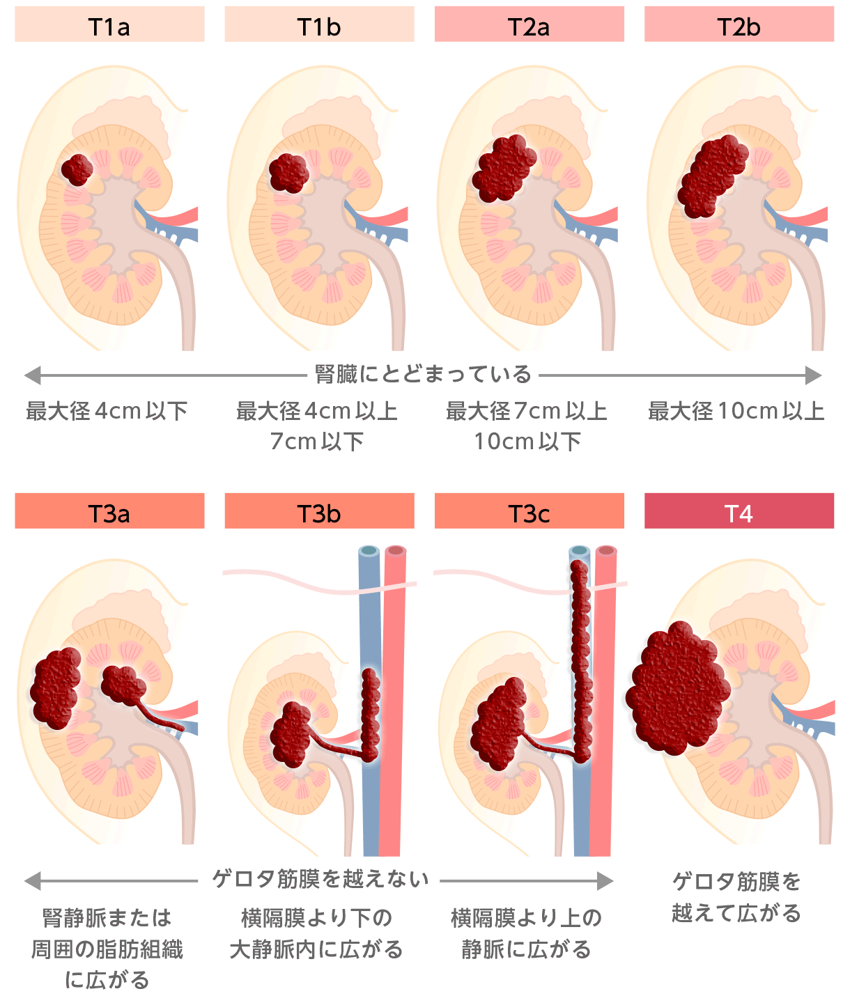 図5：【参考】腎がんの大きさと広がりイメージ