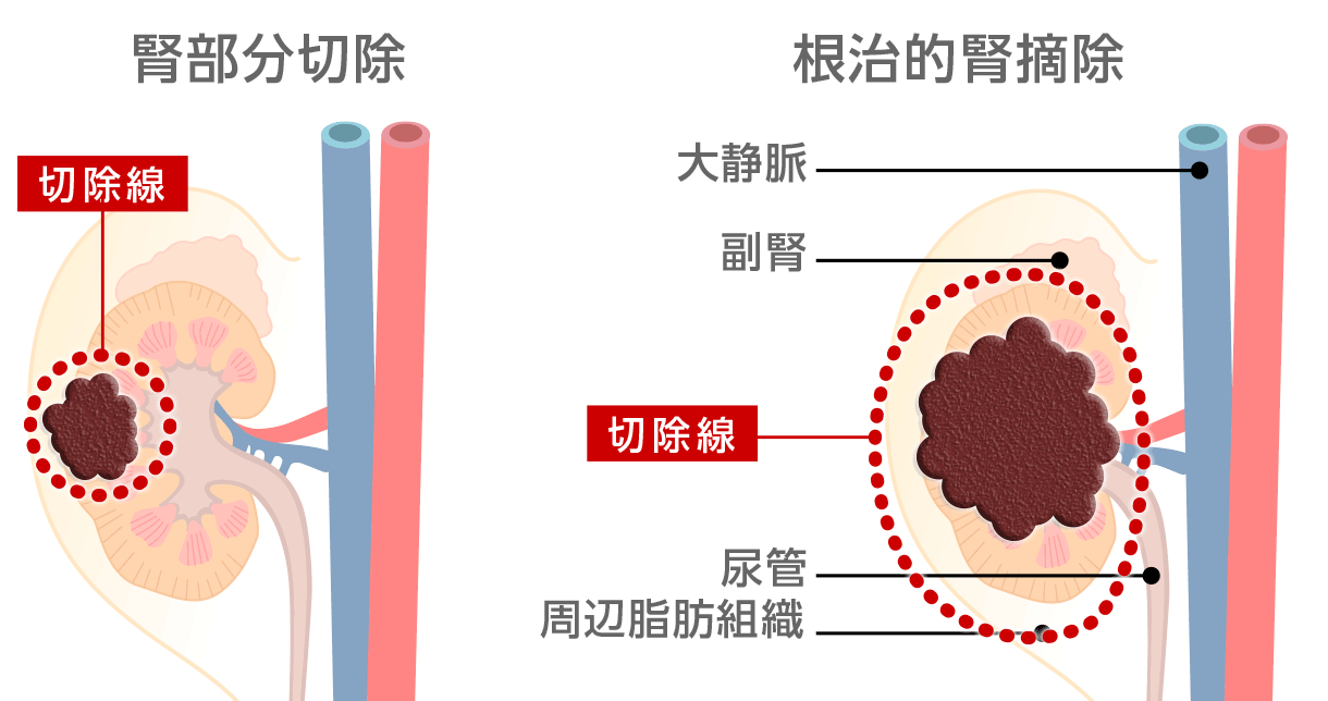 図3：腎部分切除と根治的腎摘除