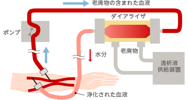 透析時の血液の流れ