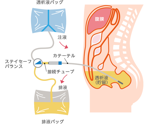 腹膜透析のしくみ