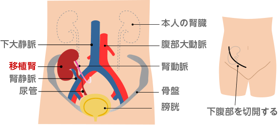 レシピエントの手術