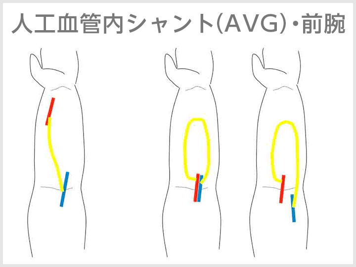 人工血管内シャント（AVG）・前腕