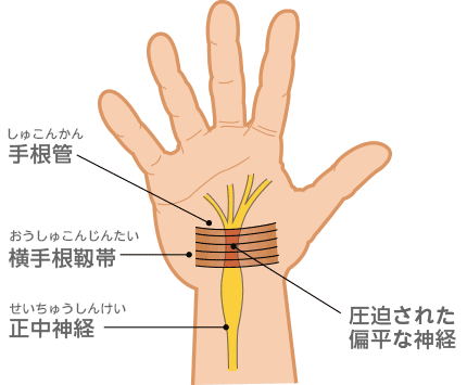 手 根 管 症候群 これ で シビレ 痛み が 消え た