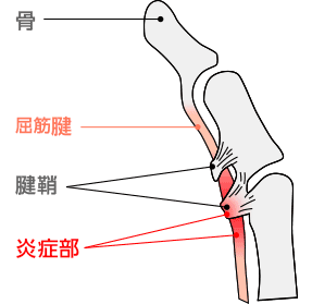 弾発指2